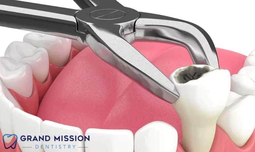 tips for halting bleeding after a tooth extraction