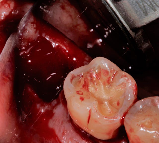 tips for halting bleeding after a tooth extraction