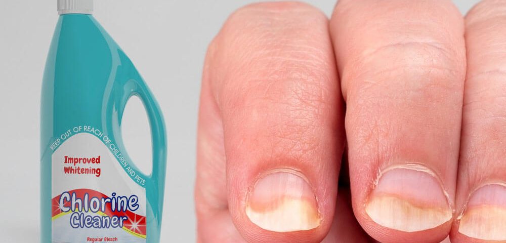 can bleach kill nail fungus：can bleach eliminate nail fungus